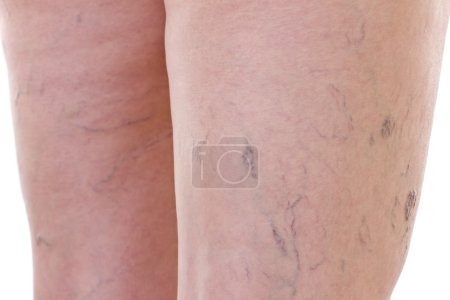 Close-up of legs with varicose veins